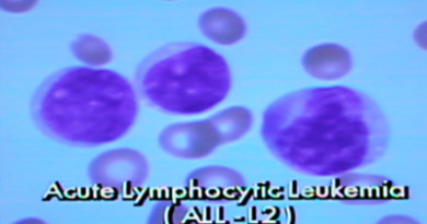 Global Acute Lymphocytic/Lymphoblastic leukemia Market 2015-2019